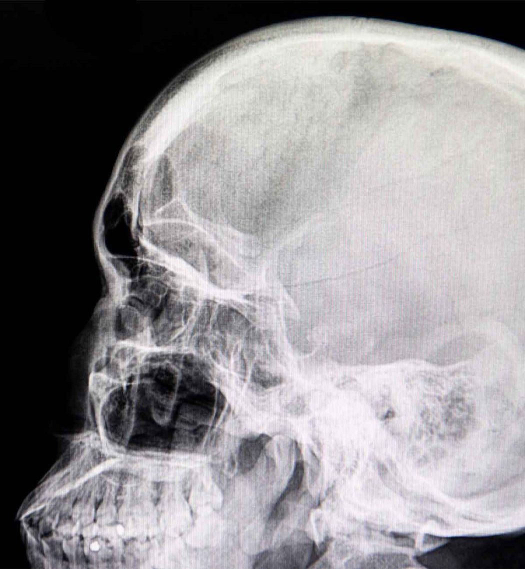 An X-ray scan showing the side of a skull that has a hairline fracture.